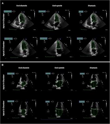 Left ventricular to left arial volume ratio in the assessment of filling pressure in patients with dyspnoea and preserved ejection fraction